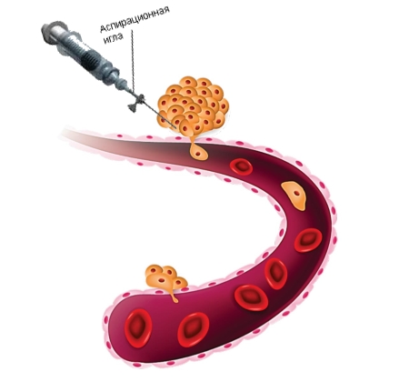 Биопсия гигромы Биопсия гигромы