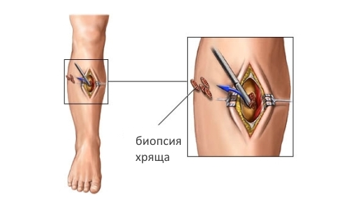 Биопсия хряща Биопсия хряща