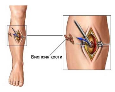 Биопсия саркомы Юинга Биопсия саркомы Юинга