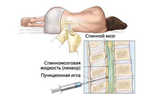 Биопсия спинного мозга Биопсия спинного мозга