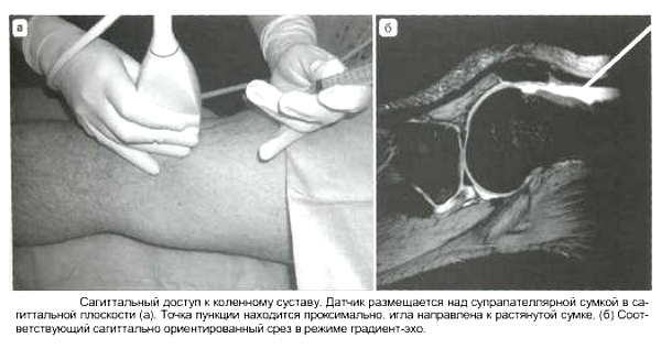 Биопсия внутрисуставной жидкости коленного сустава Биопсия внутрисуставной жидкости коленного сустава