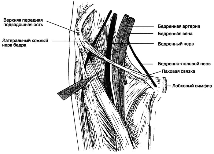 Блокада бедренного нерва Блокада бедренного нерва