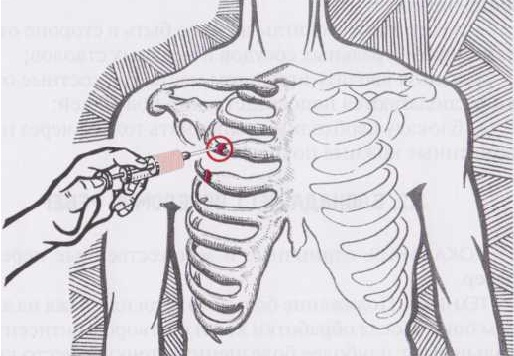 Блокада боли при переломе ребер Блокада боли при переломе ребер