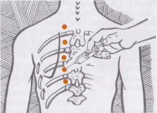 Блокада грудных позвонков и ребер