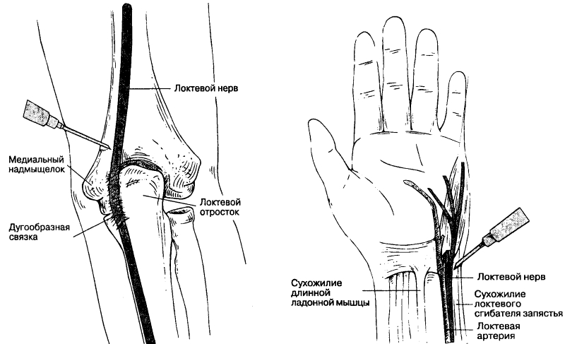 Блокада боли локтевого нерва Блокада боли локтевого нерва