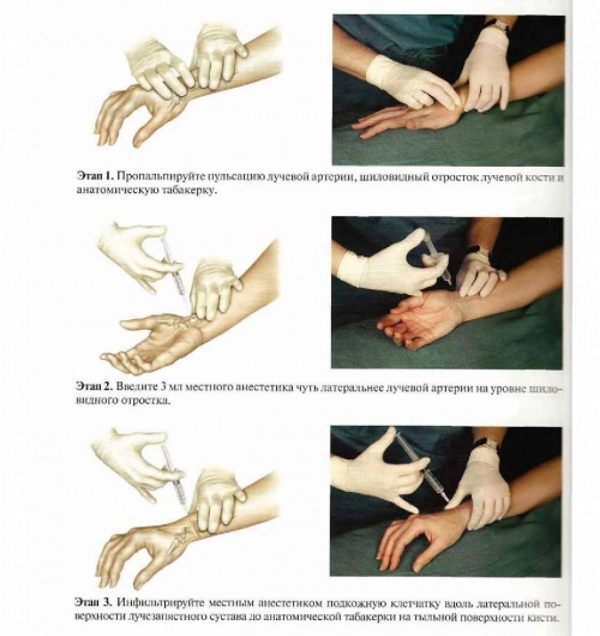 Блокада лучевых нервов запястья Блокада лучевых нервов запястья