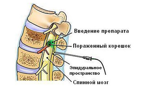 Блокада боли при ишиалгии Блокада боли при ишиалгии