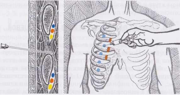 Блокада межреберных нервов Блокада межреберных нервов