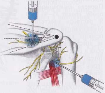 Блокада нервов лопатки Блокада нервов лопатки