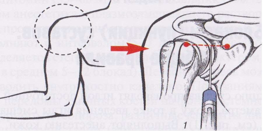 Блокада боли плечевого сустава Блокада боли плечевого сустава