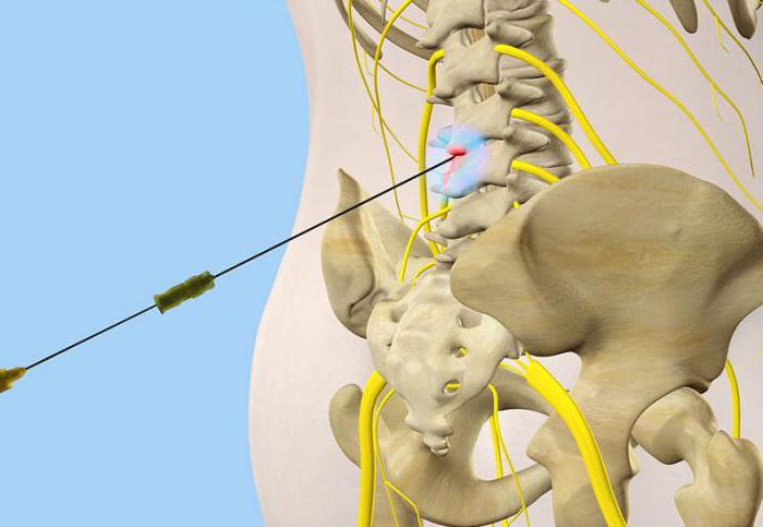 Блокада люмбалгий позвоночника Блокада люмбалгий позвоночника
