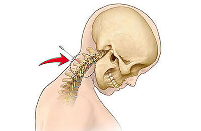 Блокада боли при шейном радикулите Блокада боли при шейном радикулите