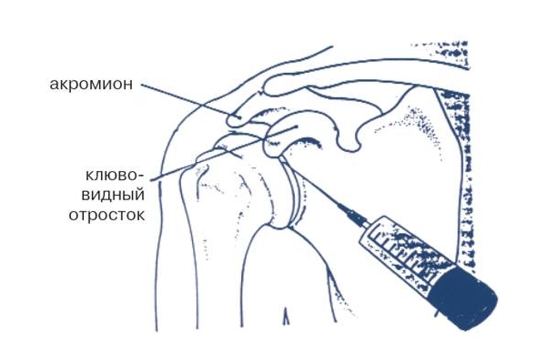 Пункция плечевого сустава для блокады воспаления при полиартрите Пункция плечевого сустава для блокады воспаления при полиартрите