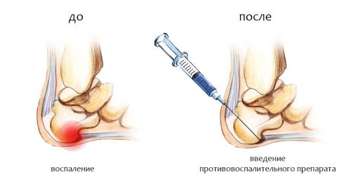 Блокада боли при пяточной шпоре Блокада боли при пяточной шпоре