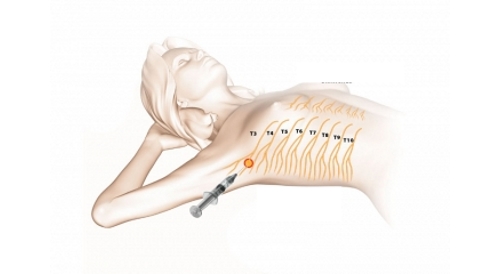Блокада в область пораженного нерва Блокада в область пораженного нерва