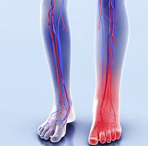 Боль и отек Боль и отек