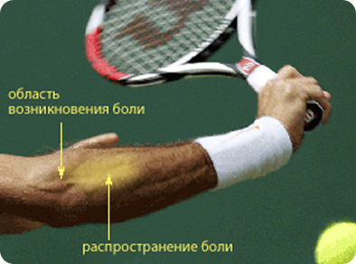 Боль при эпикондилите Боль при эпикондилите