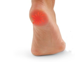 Боль при ходьбе при пяточной шпоре Боль при ходьбе при пяточной шпоре