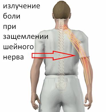 Боль при защемлении нерва шейного отдела Боль при защемлении нерва шейного отдела