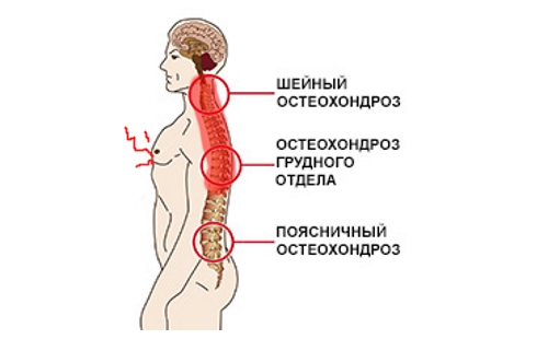 Очаги остеохондроза Очаги остеохондроза