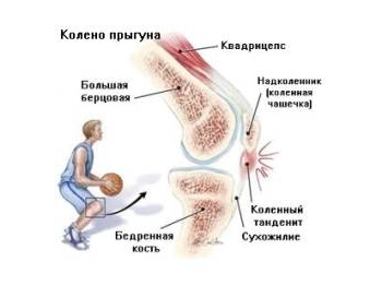 Боль вследствие нагрузки Боль вследствие нагрузки