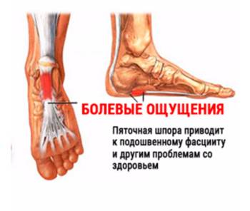 Болевые ощущения при пяточной шпоре Болевые ощущения при пяточной шпоре