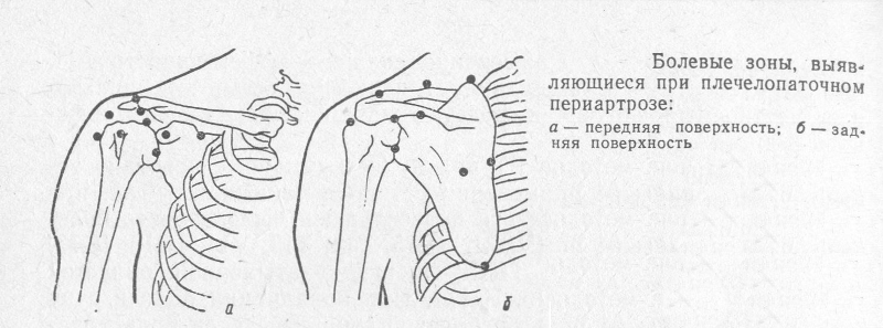 Болевые зоны при периартрозе Болевые зоны при периартрозе