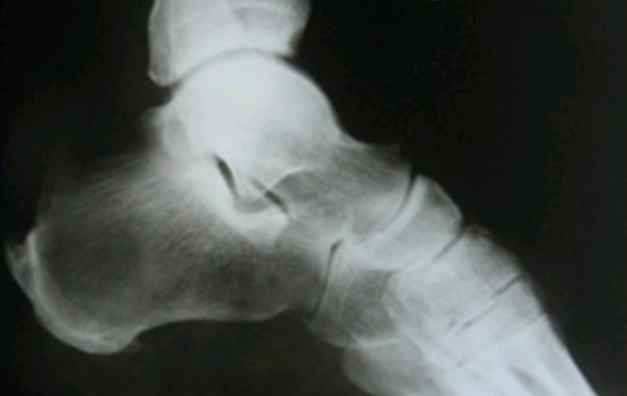 Болезнь Хаглунда-Шинца на рентген снимке Болезнь Хаглунда-Шинца на рентген снимке