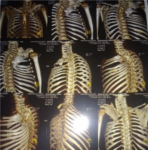 Болезнь Шпренгеля Болезнь Шпренгеля