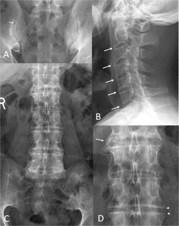 Болезнь Бехтерева на рентген снимке Болезнь Бехтерева на рентген снимке