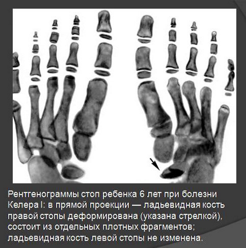 Болезнь Келлера 1 вида на рентген снимке Болезнь Келлера 1 вида на рентген снимке