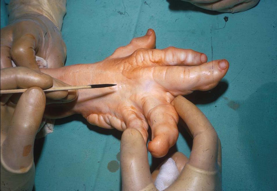 Болезнь Олье рук Болезнь Олье рук