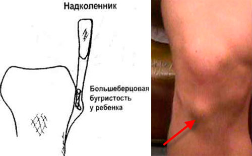 Бугристость при болезни Шляттера Бугристость при болезни Шляттера