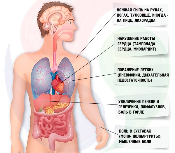 Симптомы болезни Стилла Симптомы болезни Стилла