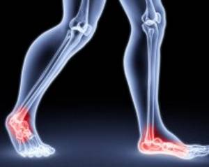 Боли в области пяточной кости Боли в области пяточной кости