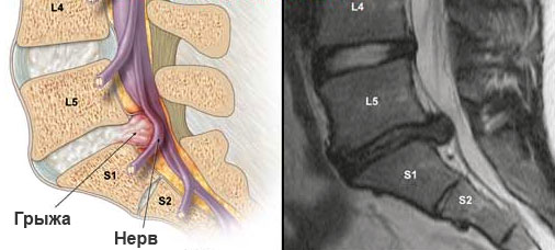 Большой размер грыжи поясничного отдела позвоночника Большой размер грыжи поясничного отдела позвоночника