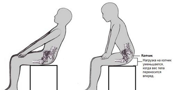 Боль в области копчика Боль в области копчика