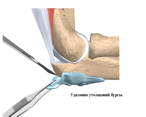 Бурсоэктомия локтевого сустава Бурсоэктомия локтевого сустава