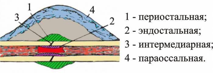 Части костной мозоли Части костной мозоли