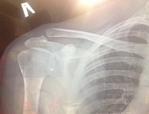 Частичный разрыв АКС на рентген снимке Частичный разрыв АКС на рентген снимке