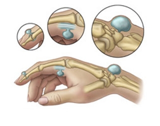 Частые расположения шишек на пальцах рук Частые расположения шишек на пальцах рук