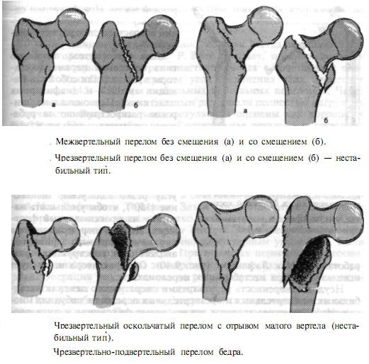 Чрезвертельный и межвертельный переломы бедра Чрезвертельный и межвертельный переломы бедра