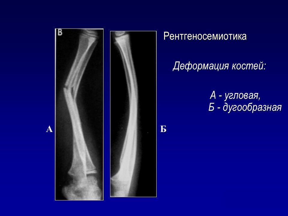 Назначение остеотомии при деформации костей Назначение остеотомии при деформации костей
