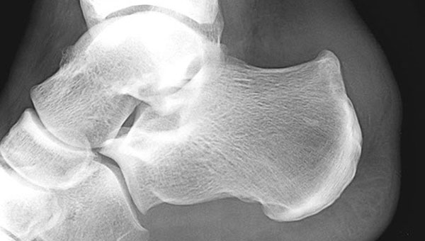 Деформация Хаглунда на рентгене Деформация Хаглунда на рентгене