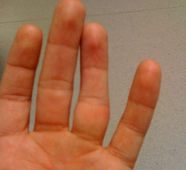 Деформация и отек при вывихе пальца Деформация и отек при вывихе пальца