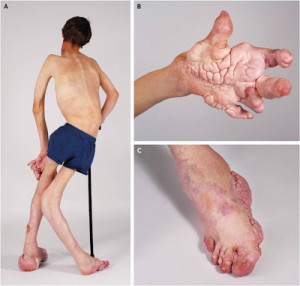Деформация костей при синдроме Маффуччи Деформация костей при синдроме Маффуччи
