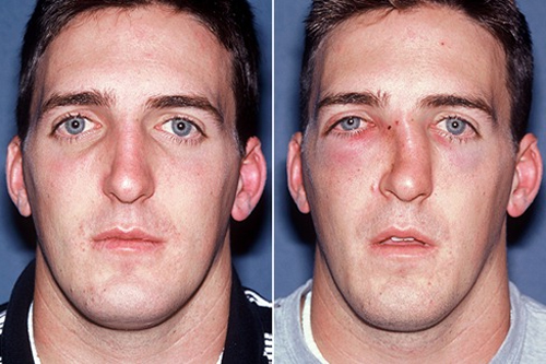 Деформация носа