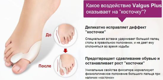Действие фиксатора Valgus-Plus Действие фиксатора Valgus-Plus