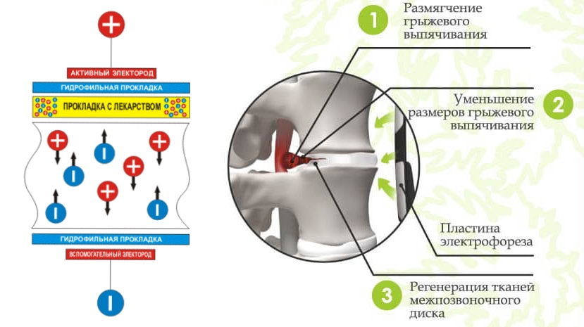 Действие электрофореза на грыжу диска Действие электрофореза на грыжу диска