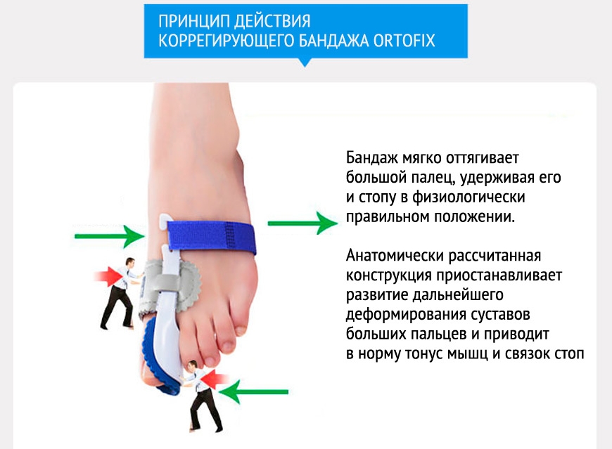 Действие фиксатора Ortofix Gess Действие фиксатора Ortofix Gess